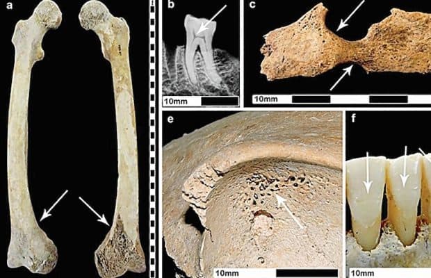 Roma Kentleşmesi Sağlık için Zararlıydı