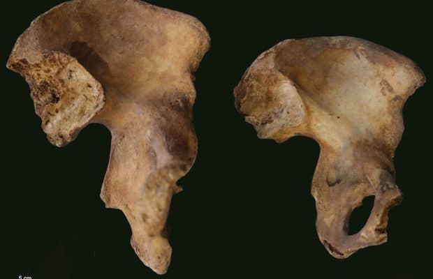 İskeletlerdeki İzler Yaşlanmaya mı Hastalığa mı Ait?