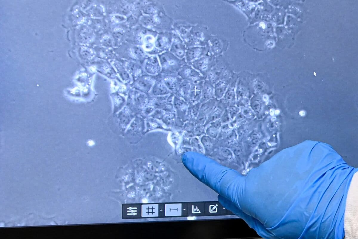 AI Spots Pancreatic Cancer Years Before It Shows Up, Study Finds