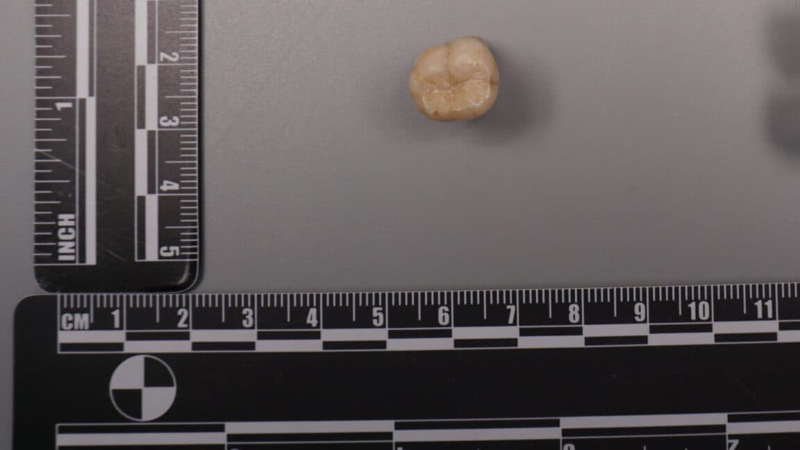 Protein Found in Homo Erectus Teeth Indicates Denisovan DNA Contribution