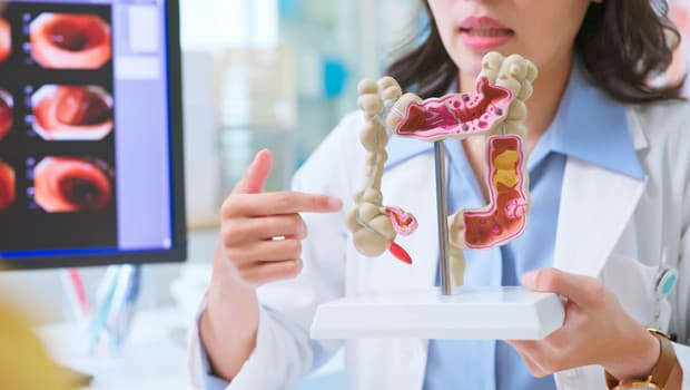 Bağırsak kanseri neden gençlerde artıyor? Uzman isim 4 büyük riski tek tek sıraladı