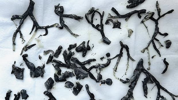 Nefes darlığı şikâyeti vardı, doktorlar gördüklerine inanamadı: Akciğerlerden ‘ağaç dalları’ çıktı!