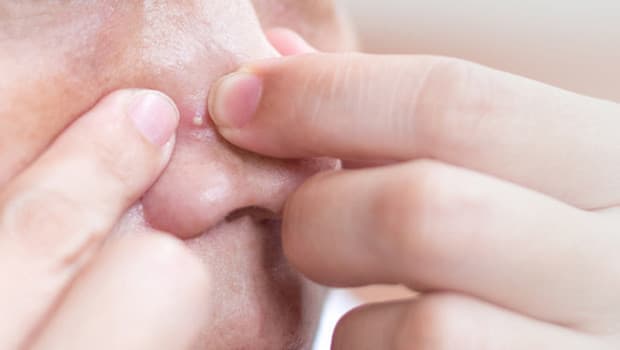 Sivilce sıkmak tehlikeli mi? Sosyal medyada görüp denemeyin