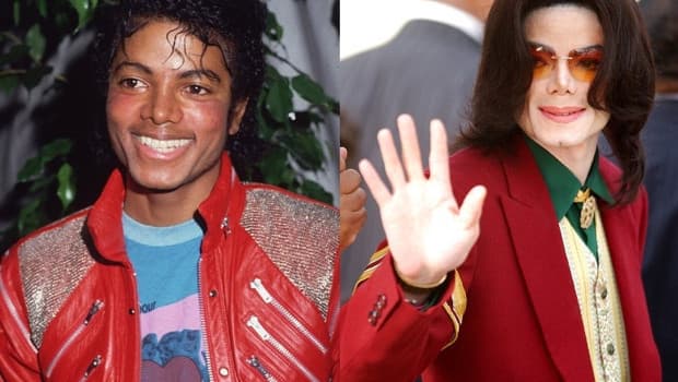 Michael Jackson’ın görüntüsünü değiştiren hastalık yeniden gündemde: Vitiligo nedir, kimleri etkiler?