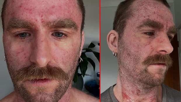 30 yıl süren deri hastalığına çare buldu