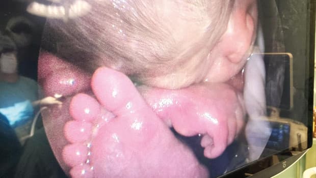 26 haftalık bebeğe anne karnında omurilik ameliyatı yapıldı