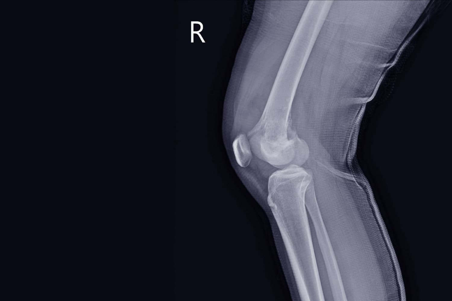 Japanese Researchers Discover Causes of Adolescent Osteosarcoma Development