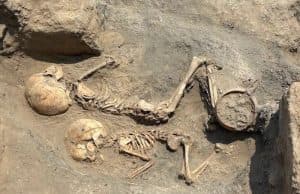 Özbekistan'da 4.000 Yıllık Çocuğa Cerrahi Müdahale Yapıldı
