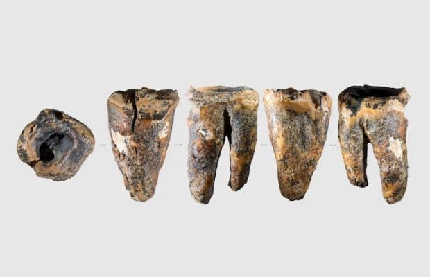 Neandertaller 60.000 Yıl Önce Diş Tedavisi Uygulamış