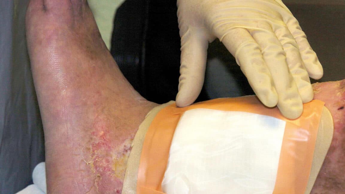 FDA Approves Second Fly Species for Maggot Therapy in Wound Care