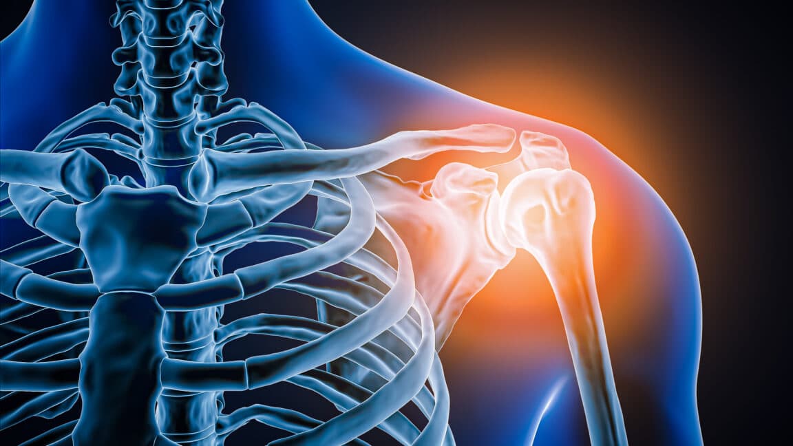 Doctors Discover Missing Joint in Patient with Severe Shoulder Pain