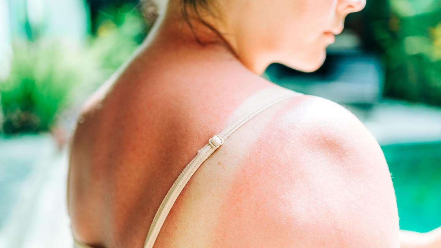 Melanoma Skin Cancer Cases in the UK Exceed 20,000 Annually for First Time