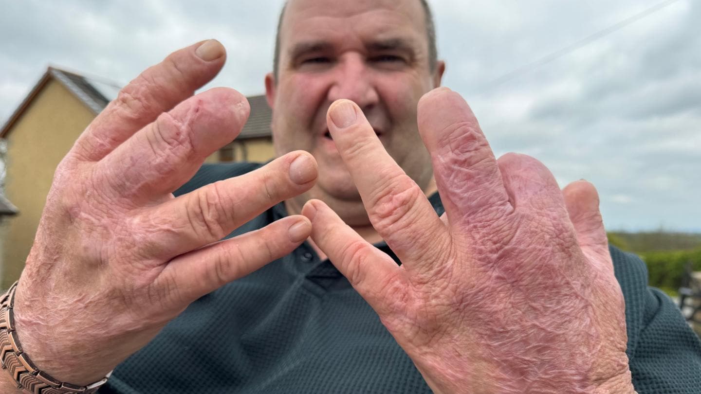 Sepsis Patient Marshall Wylie Faces Life-Altering Decision to Save His Life