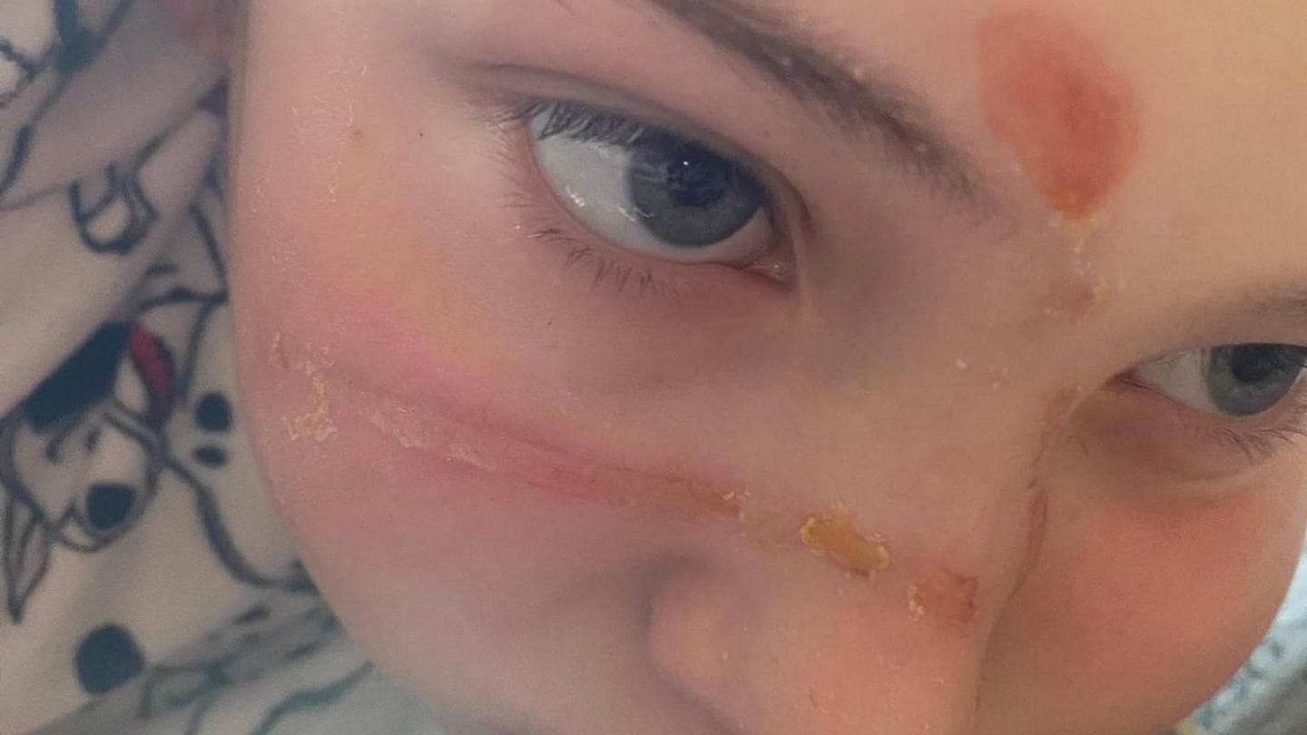 Squishy toy trend caused 'traumatising' burns