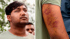 Experts Confirm Pellet Gun Injuries Among India's 'Cockroach' Protesters