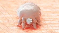 Glangwili Hospital Ward Closed Due to Crusted Scabies Outbreak