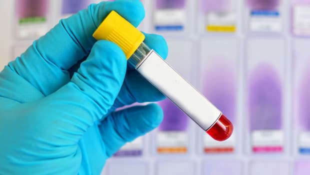 Alzheimer riski için yeni bir kan testi geliştiriliyor