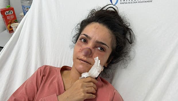 Manisa'da alkollü koca eşinin burnunu ısırarak kopardı