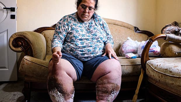 Adana'da fil hastalığıyla mücadele eden anne yardım bekliyor