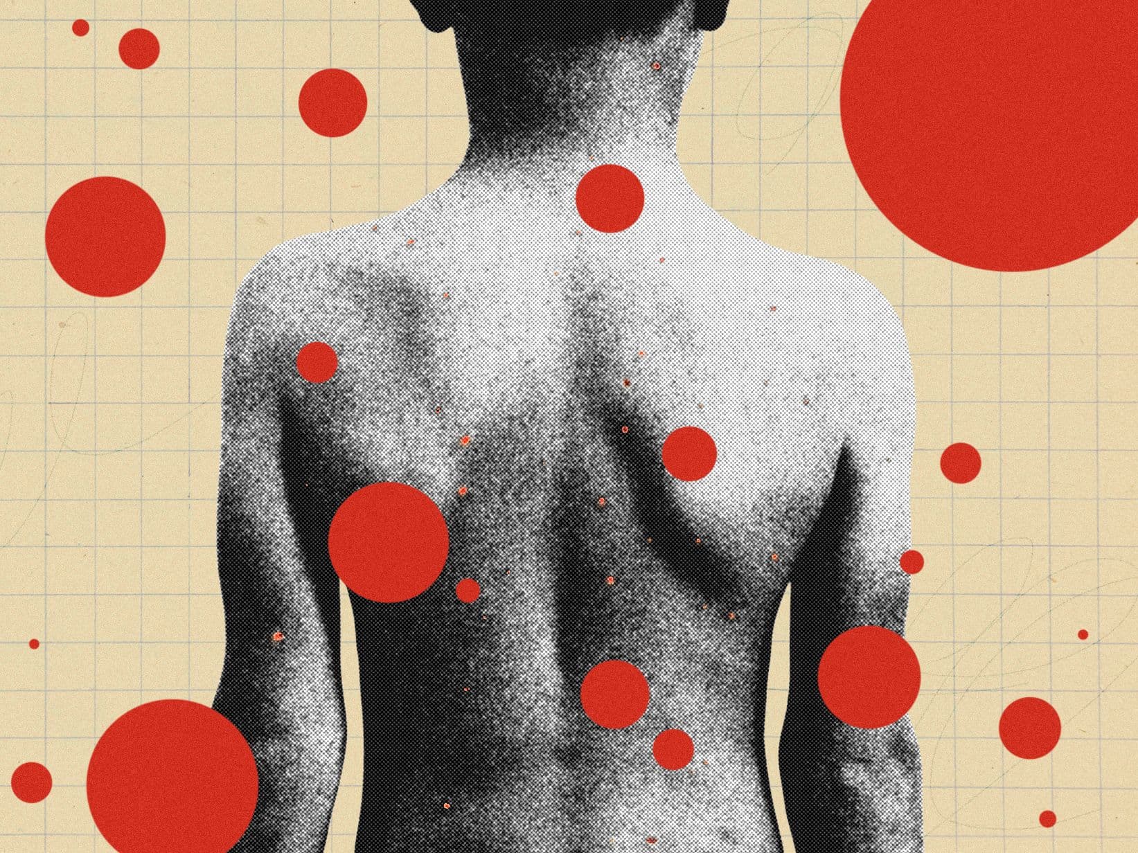 The Resurgence of Chickenpox Parties in the Age of Vaccines