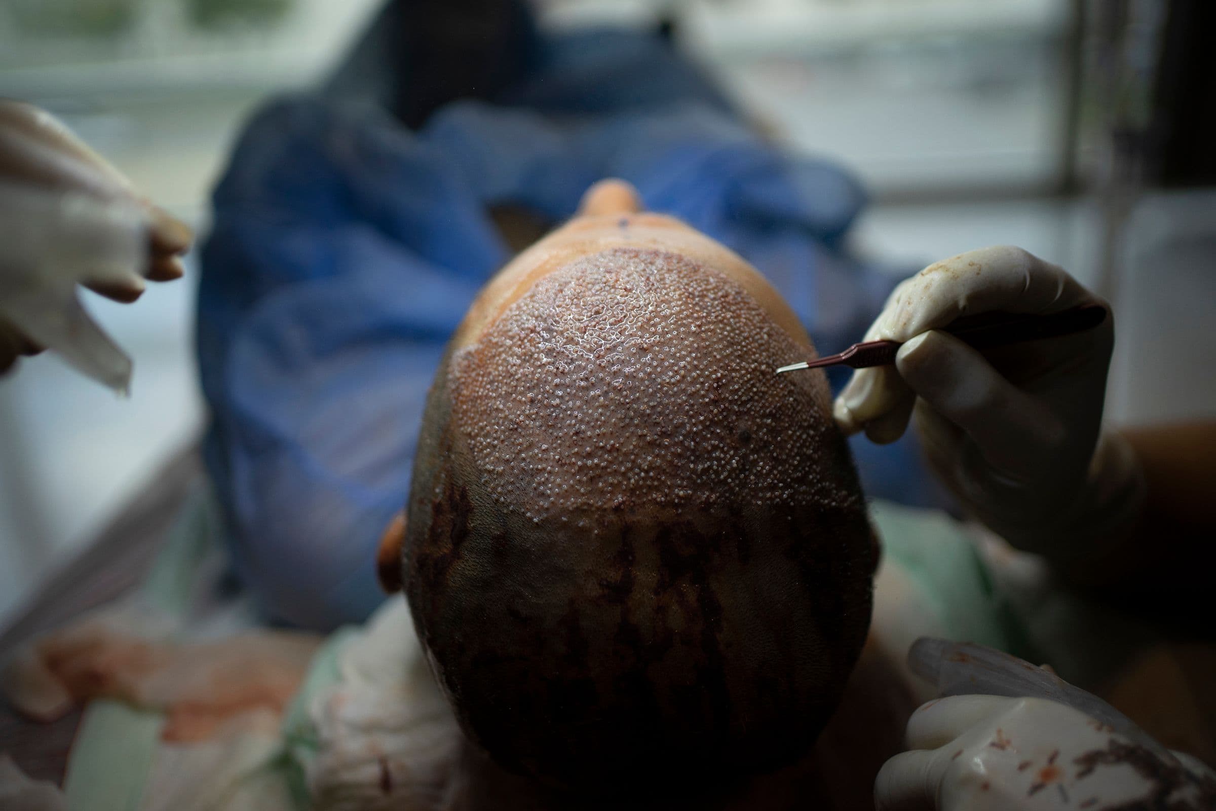 Turkey's Innovative Approach Transforms the Hair Transplant Industry