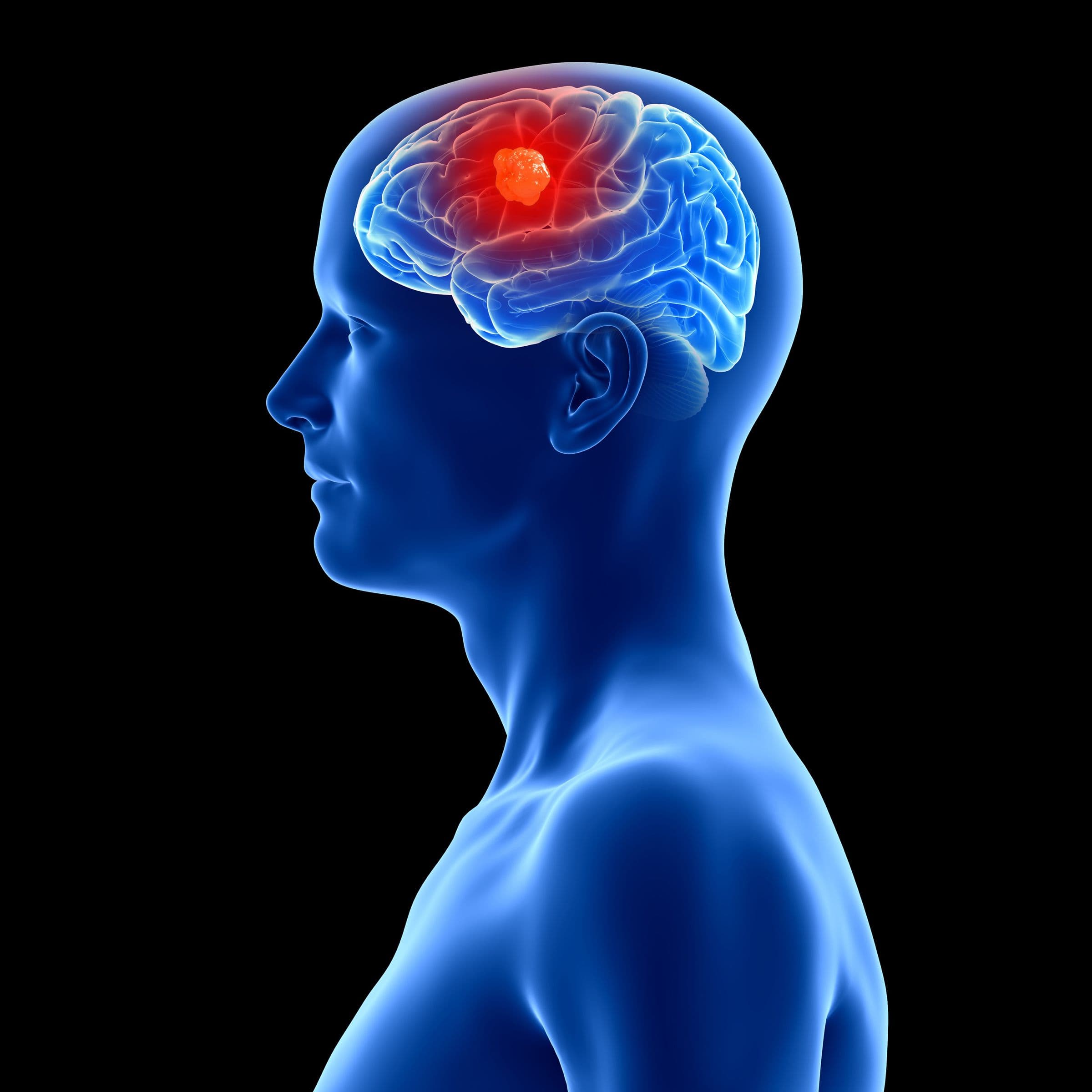 Three Patients Receive Cancer-Detecting Implants in Their Brains