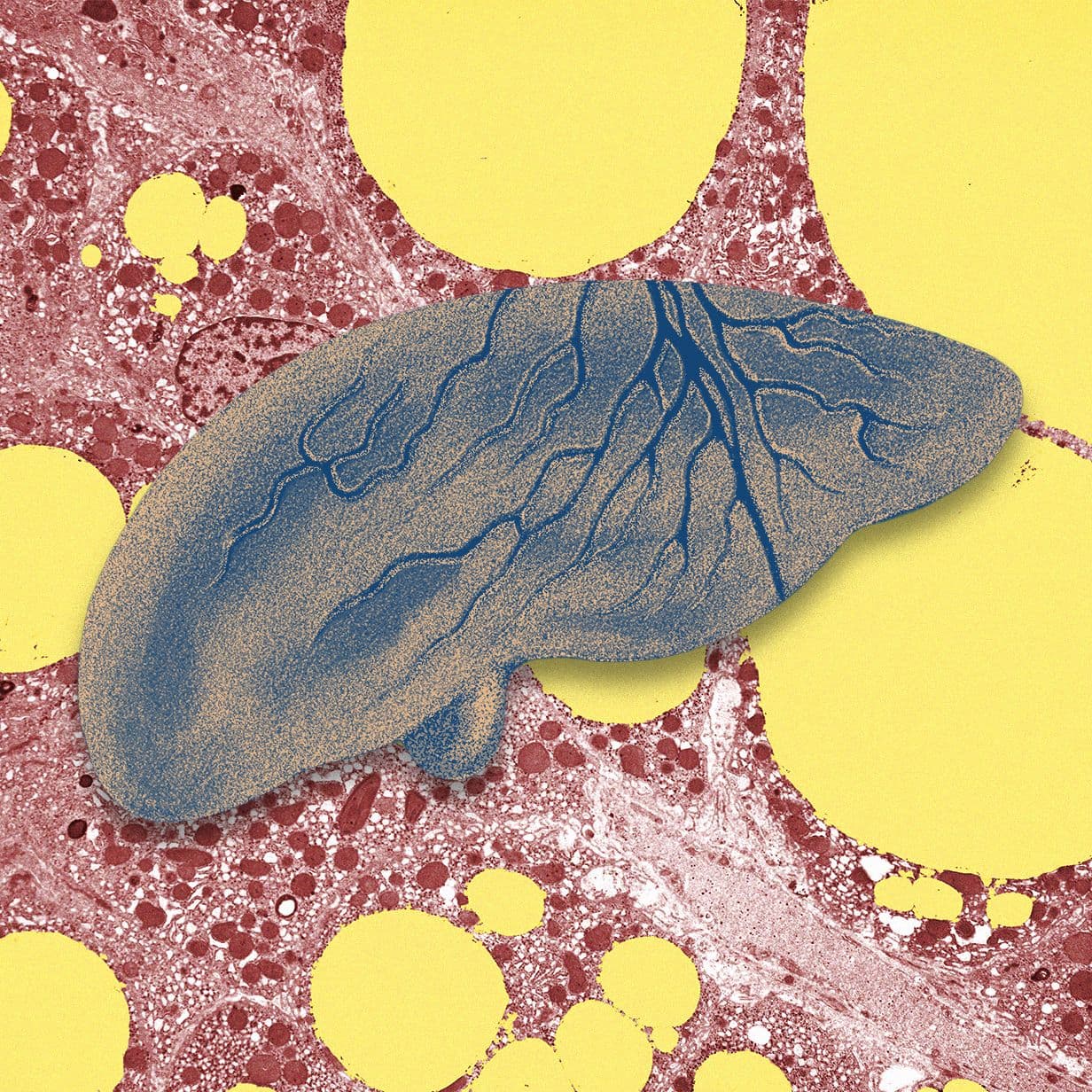 AI Tools May Help Identify and Prevent Fatty Liver Disease Epidemic