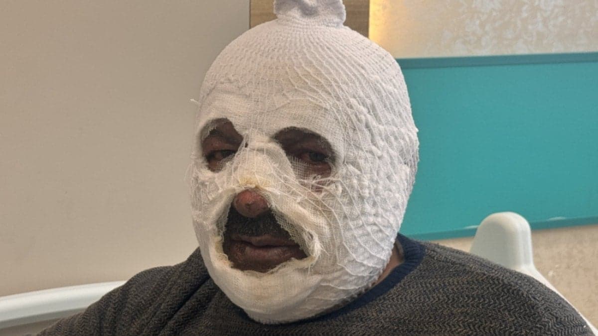 Kalorifer kazanını yakmak istedi canını zor kurtardı