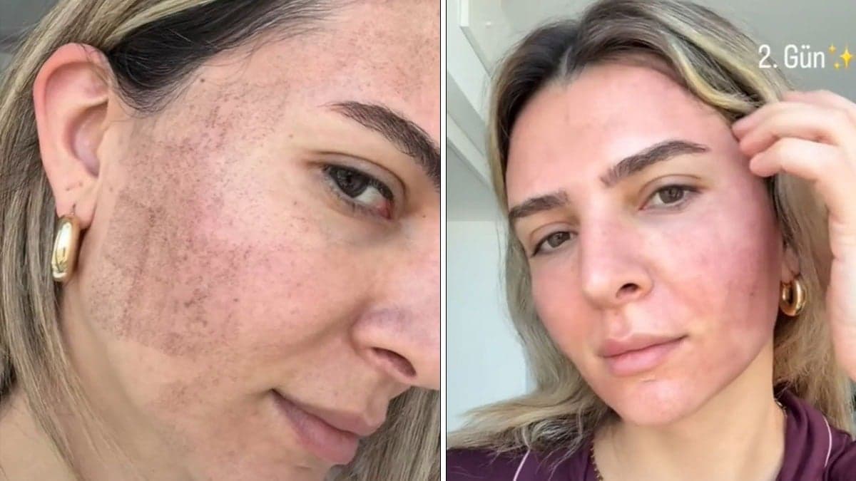 Merve Aydın'ın cilt tedavisi sonucu dikkat çekici değişim