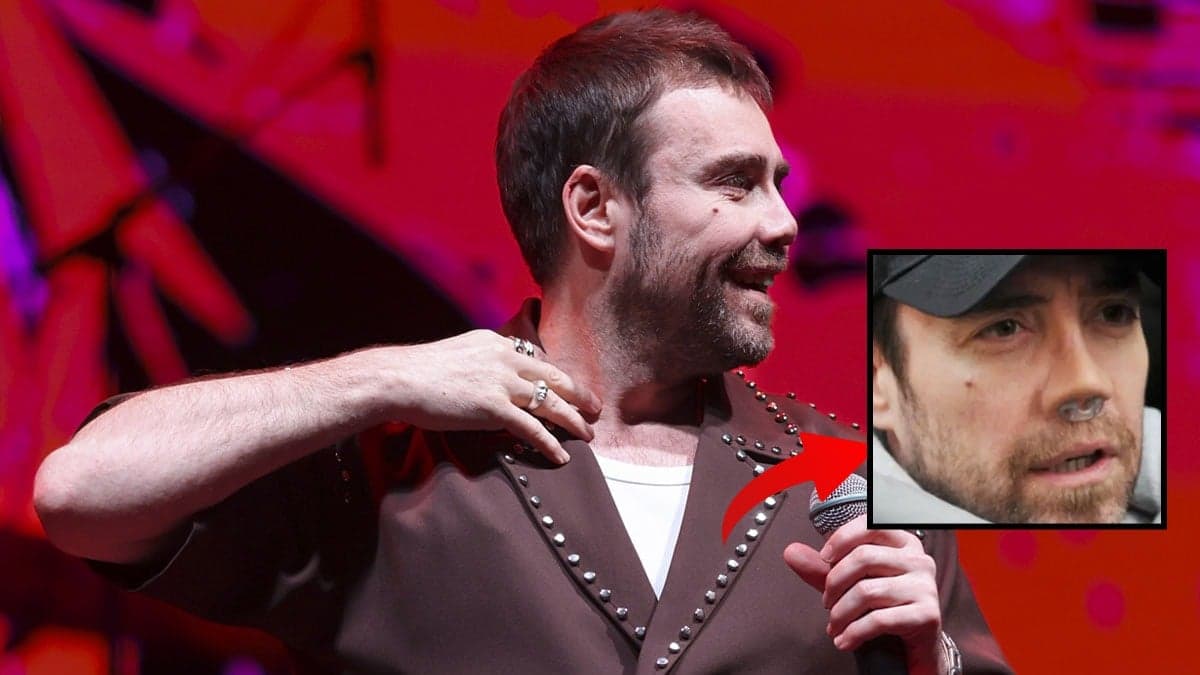 Burun ameliyatı sonrası sahnelere geri döndü; Murat Dalkılıç'ın son haline yorum yağdı
