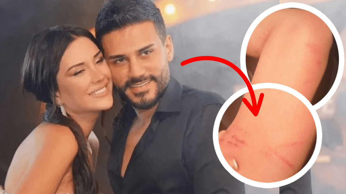 Dilan Polat darp izlerini paylaştı, ardından sildi.