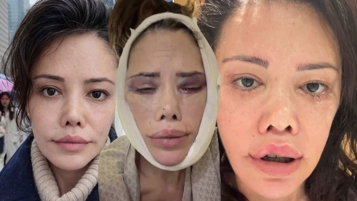 Didem Ceran, yüz nakli sonrası yeniden ameliyat oldu