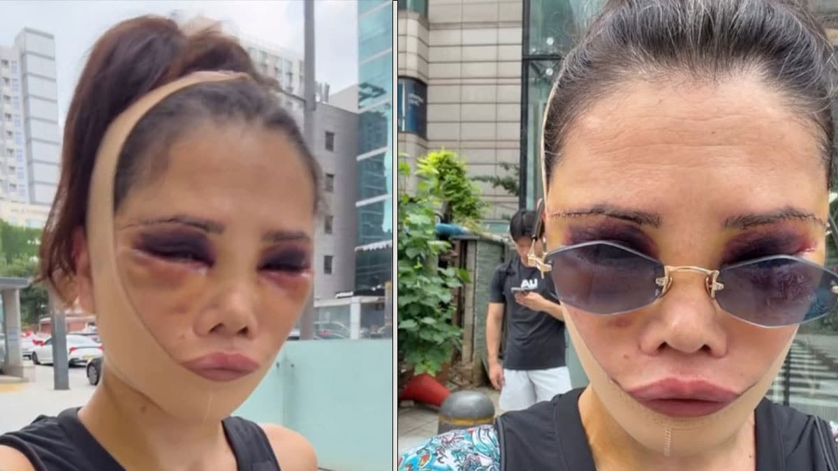 Didem Ceran yeniden estetik ameliyatı geçirdi ve son halini paylaştı