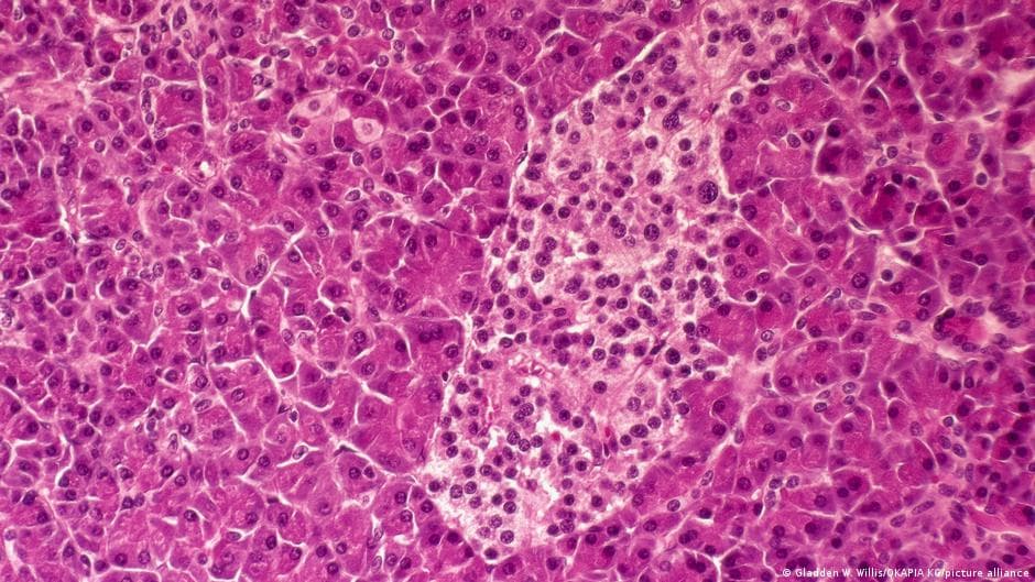 New Drug Daraxonrasib Doubles Survival for Pancreatic Cancer Patients