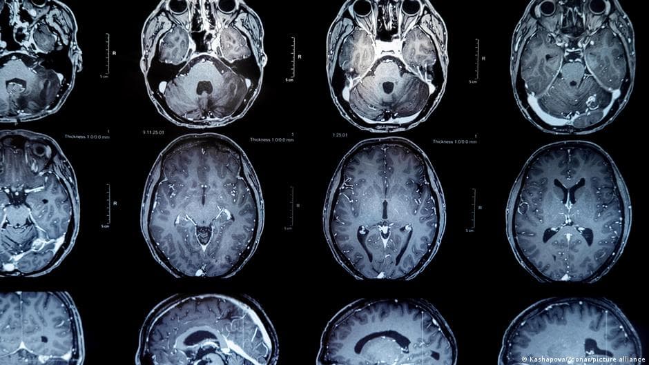 New Vaccine Provides Hope for Patients with Brain Tumors