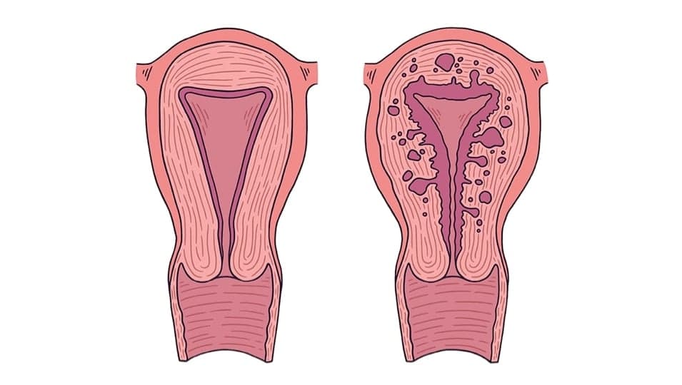Adenomyozis: Uterus İçinde Anormal Endometriyal Doku Büyümesi