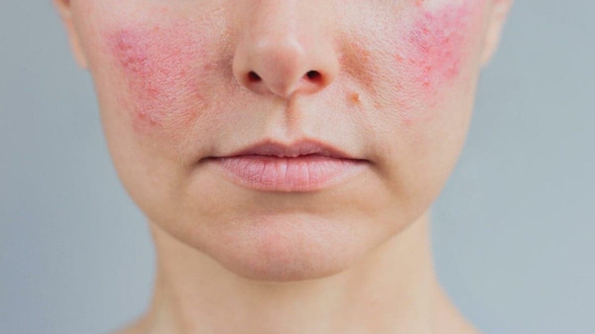 Histamin Kızarması Nedir ve Vücudumuz İçin Anlamı