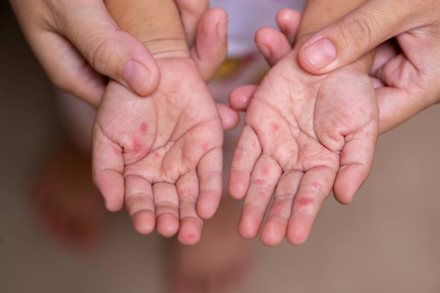 Cases of Hand, Foot and Mouth Disease Rise Across Japan as Summer Begins