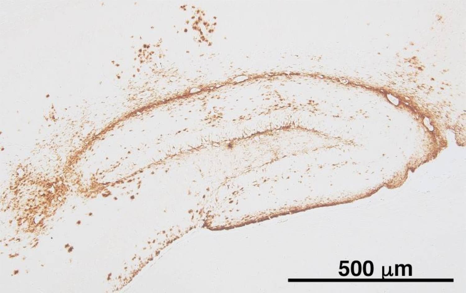 Japanese Scientists Discover Protein Clusters Linked to Alzheimer's Disease